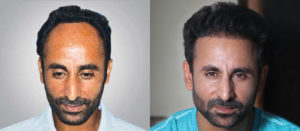 hair transplant in Ludhiana price